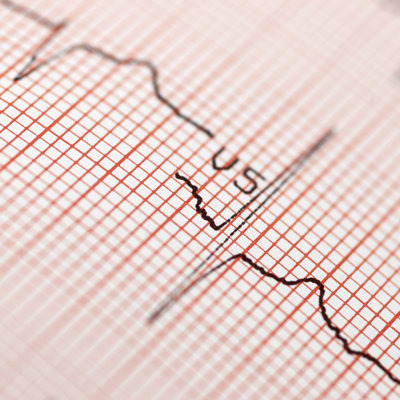 EKG -Registrierpapier