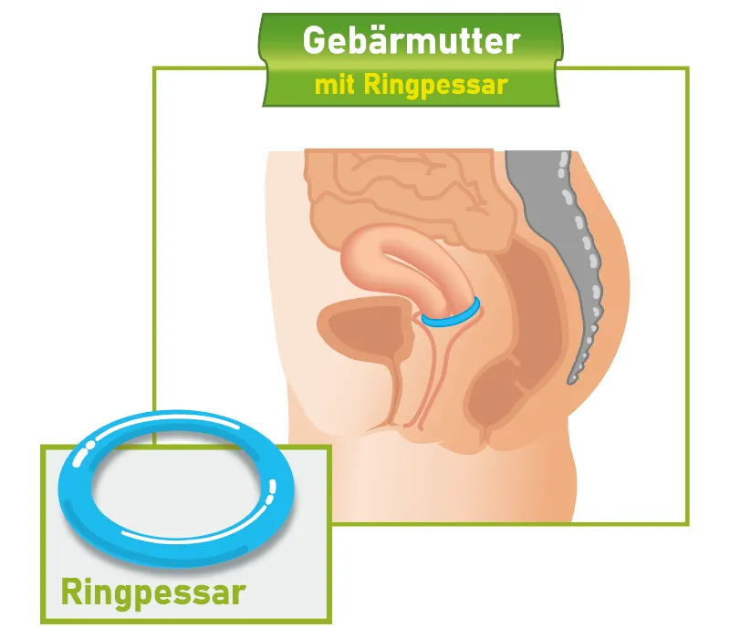 Querschnitt weibliches Becken mit Ringpessar Querschnitt des weiblichen Beckens mit eingesetztem Ringpessar.