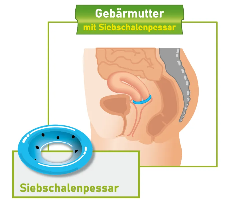 Querschnitt weibliches Becken mit Siebschalenpessar Querschnitt des weiblichen Beckens mit eingesetztem Siebschalenpessar.