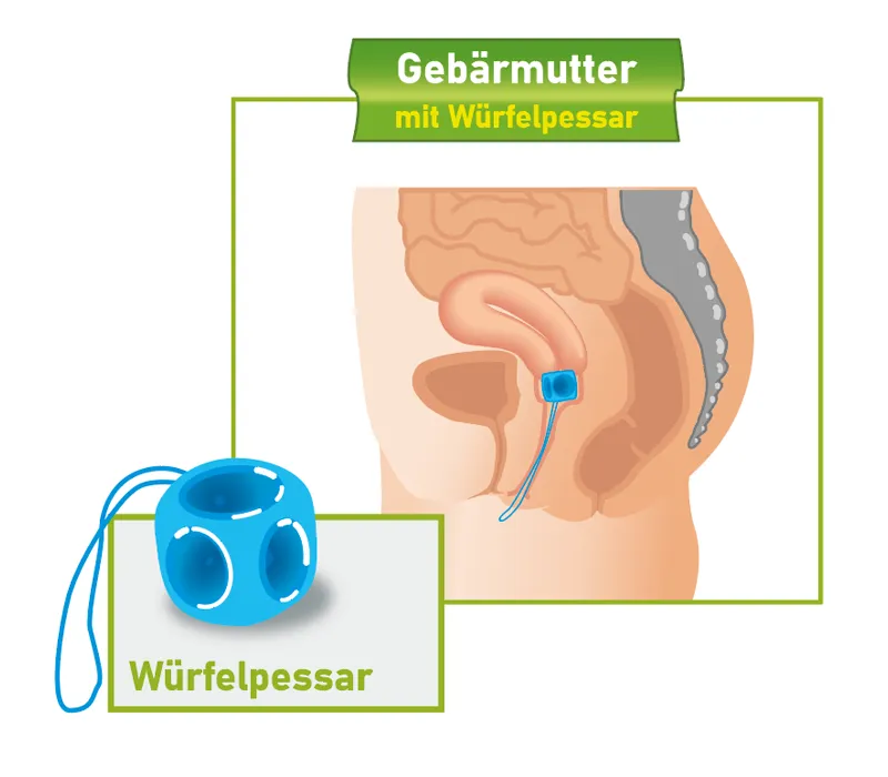 Querschnitt weibliches Becken mit Wuerfelpessar Querschnitt des weiblichen Beckens mit eingesetztem Wuerfelpessar.