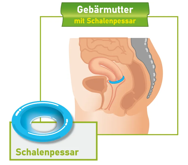 Querschnitt des weiblichen Beckens mit eingesetztem Schalenpessar.