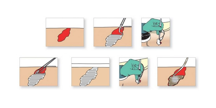 Anwendungsbeispile für das Ligasano Wundband micro mit Wundputzer